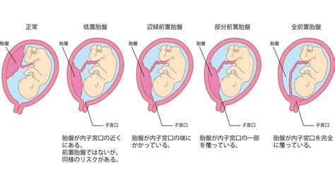 低位性前置胎盤